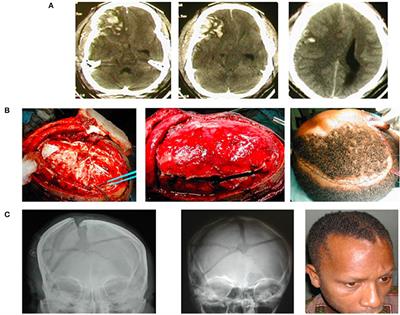 Cranioplasty Following Decompressive Craniectomy